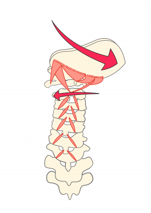 イラスト5_歪んだ頸椎と筋肉+矢印